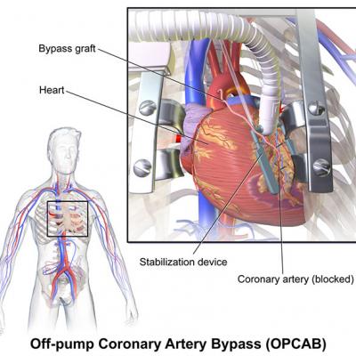 Off Pump Coronary Artery Bypass Surgery. Why does it work in practice but not in theory!
