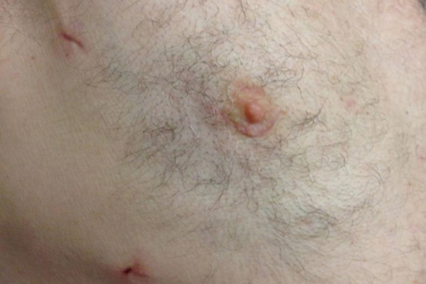 Periareolar scar after cardiac tumour excision