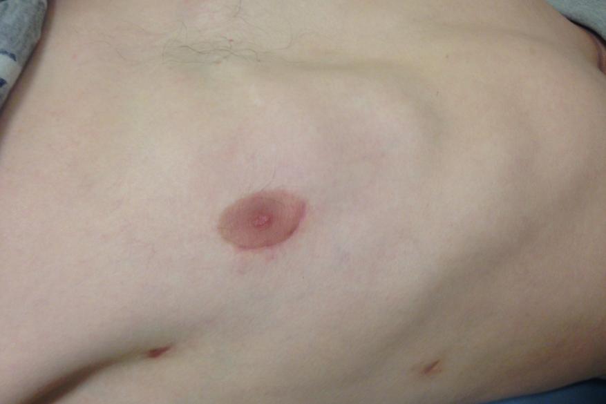 Periareolar scar at 3 months after an ASD closure