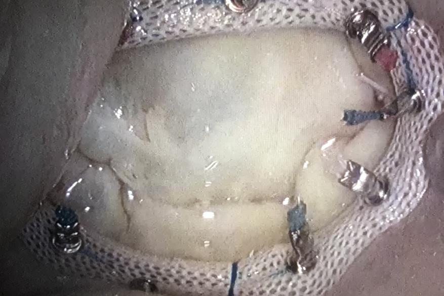 An endoscopic view of a repaired mitral valve 