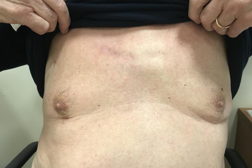 The scar at 3 months after an ART procedure for an aortic valve replacement